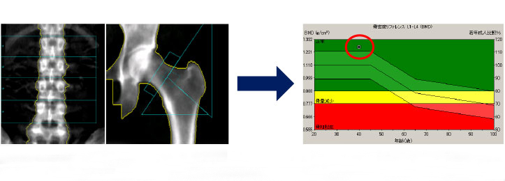 骨粗鬆症の症状